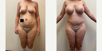 Case 208 - Woman treated with Breast Augmentation, Tummy Tuck