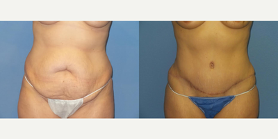 Case 2080 - 40 year old woman treated with Tummy Tuck