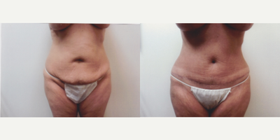 Case 2082 - 51 year old woman treated with Tummy Tuck