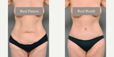 Case 2083 - 45-54 year old woman treated with Tummy Tuck