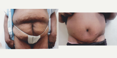 Case 2084 - 45-54 year old woman treated with Tummy Tuck