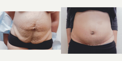 Case 2085 - 35-44 year old woman treated with Tummy Tuck