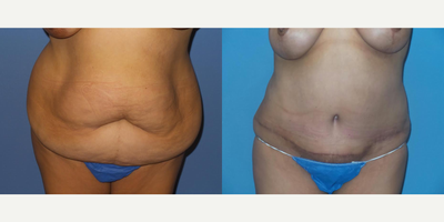 Case 2086 - 35-44 year old woman treated with Tummy Tuck