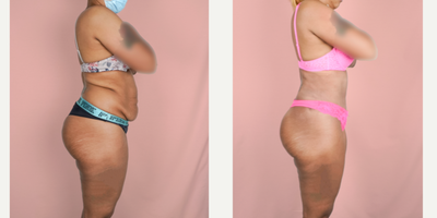 Case 2088 - 25-34 year old woman treated with Tummy Tuck