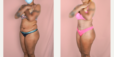 Case 2089 - 25-34 year old woman treated with Tummy Tuck, Vaser Liposuction