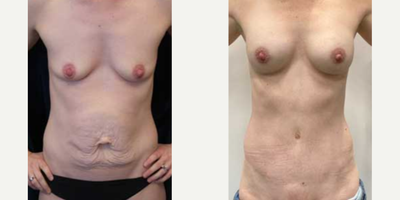Case 209 - Woman treated with Tummy Tuck