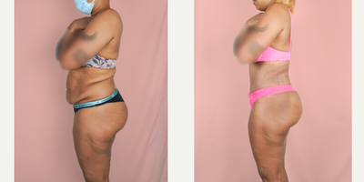 Case 2090 - 25-34 year old woman treated with Tummy Tuck