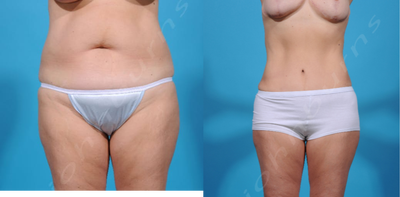 Case 2091 - 35-44 year old woman treated with Tummy Tuck