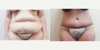 Case 2094 - 55-64 year old woman treated with Tummy Tuck