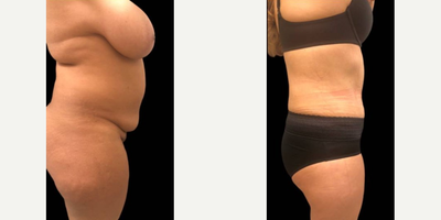 Case 2096 - 55-64 year old woman treated with Tummy Tuck
