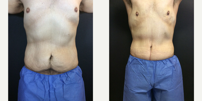Case 2097 - 35-44 year old man treated with Liposuction