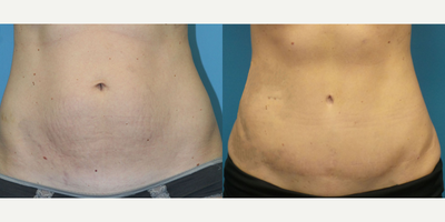 Case 2099 - 35-44 year old woman treated with Tummy Tuck