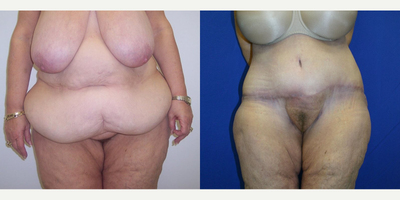 Case 21 - Woman treated with Tummy Tuck