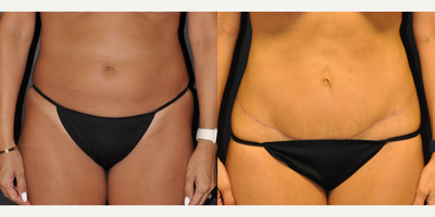 Case 2101 - 42 year old woman treated with Floating Umbilicus Tummy Tuck