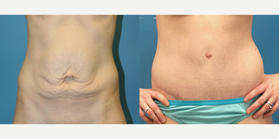 Case 2102 - 35-44 year old woman treated with Tummy Tuck