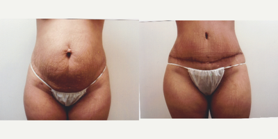 Case 2103 - 18-24 year old woman treated with Tummy Tuck