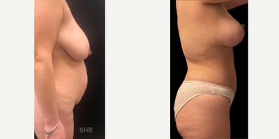 Case 2104 - 35-44 year old woman treated with Tummy Tuck, Breast Lift, Breast Implants, Mommy Makeover