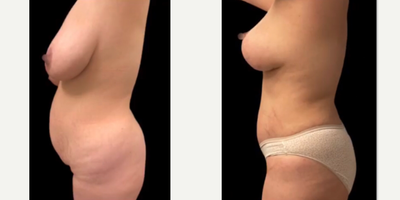 Case 2105 - 35-44 year old woman treated with Tummy Tuck, Breast Lift, Breast Implants, Mommy Makeover