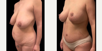 Case 2106 - 35-44 year old woman treated with Tummy Tuck, Breast Lift, Breast Implants, Mommy Makeover
