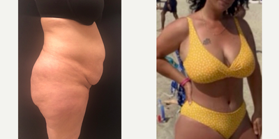 Case 2107 - 35-44 year old woman treated with Tummy Tuck, Liposuction, Mommy Makeover