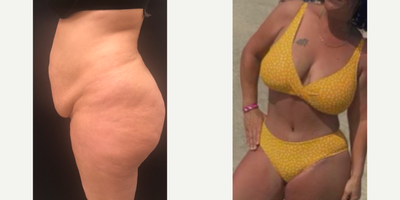 Case 2108 - 35-44 year old woman treated with Tummy Tuck, Liposuction, Mommy Makeover