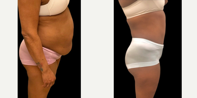 Case 2109 - 45-54 year old woman treated with Tummy Tuck, Liposuction, Mommy Makeover