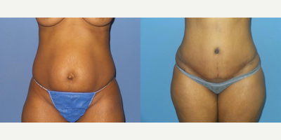 Case 2110 - 37 year old woman treated with Tummy Tuck