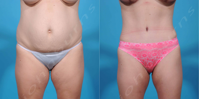 Case 2111 - 35-44 year old woman treated with Tummy Tuck