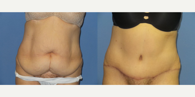 Case 2112 - 75  old woman treated with Tummy Tuck