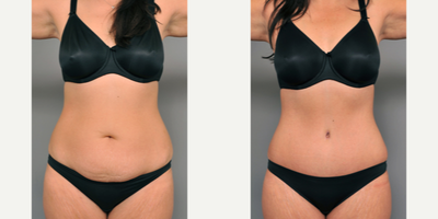 Case 2113 - 35-44 year old woman treated with Tummy Tuck