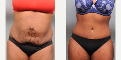 Case 2114 - 35-44 year old woman treated with Tummy Tuck