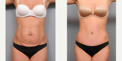 Case 2115 - 35-44 year old man treated with Tummy Tuck