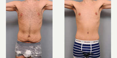 Case 2116 - 25-34 year old man treated with Tummy Tuck