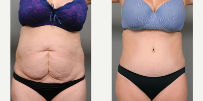 Case 2117 - 35-44 year old woman treated with Tummy Tuck