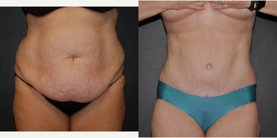 Case 2119 - 35 year old woman treated with Extended Tummy Tuck