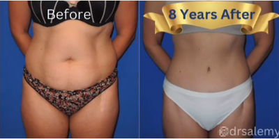 Case 212 - Woman treated with Tummy Tuck