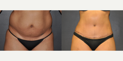 Case 2121 - 38 year old woman treated with Tummy Tuck and Liposuction