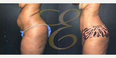 Case 2123 - Woman treated with Tummy Tuck