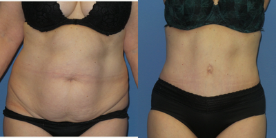 Case 2125 - 55-64 year old woman treated with Tummy Tuck