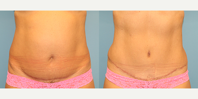 Case 2129 - 50 year old woman treated with Tummy Tuck