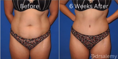 Case 213 - Woman treated with Tummy Tuck