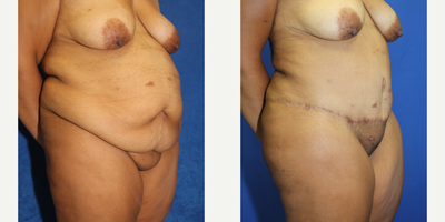 Case 2130 - 25-34 year old woman treated with Tummy Tuck