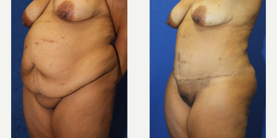 Case 2131 - 25-34 year old woman treated with Tummy Tuck