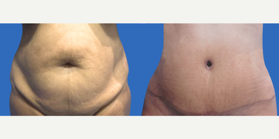 Case 2132 - 55-64 year old woman treated with Tummy Tuck