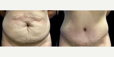 Case 214 - Woman treated with Tummy Tuck, Liposuction