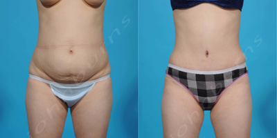 Case 2149 - 35-44 year old woman treated with Tummy Tuck