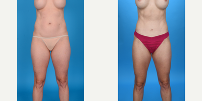 Case 215 - 35-44 year old woman treated with Abdominal Etching, Tummy Tuck, Tumescent Liposuction, Mini Tummy Tuck, Diastasis Recti Repair,