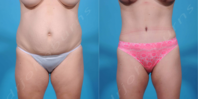 Case 2151 - 35-44 year old woman treated with Tummy Tuck