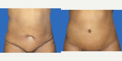 Case 2152 - 35-44 year old woman treated with Tummy Tuck