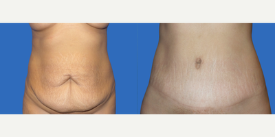 Case 2153 - 35-44 year old female treated with Tummy Tuck
